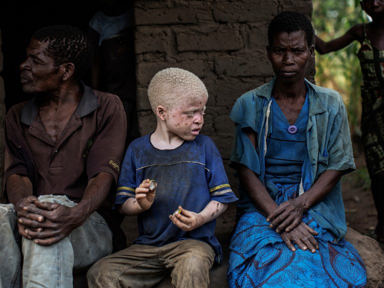 Les albinos des Grands Lacs africains